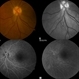 Intraretinal Microvascular Abnormalities Intraretinal Microvascular Abnormalities