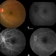 Pregnancy Induced HTN Retinopathy Pregnancy Induced HTN Retinopathy