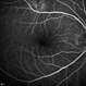 Unilateral Acute Idiopathic Maculopathy - Fluorescein Angiography (1) Unilateral Acute Idiopathic Maculopathy - Fluorescein Angiography (1)