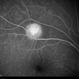 Unilateral Acute Idiopathic Maculopathy - Fluorescein Angiography (2) Unilateral Acute Idiopathic Maculopathy - Fluorescein Angiography (2)