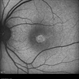 Tamoxifen Retinopathy- FAF Tamoxifen Retinopathy- FAF