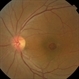 Tamoxifen Retinopathy- Fundus photo Tamoxifen Retinopathy- Fundus photo