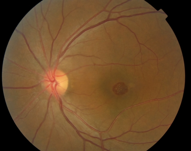 Tamoxifen Retinopathy- Fundus photo - Retina Image Bank