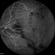 FEVR+ Optic Disc Hypoplasia 11 FEVR+ Optic Disc Hypoplasia 11