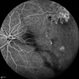 Peripheral  Nonperfusion and  Optic Disc Hypoplasia
