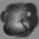 FEVR+ Optic Disc Hypoplasia 13 FEVR+ Optic Disc Hypoplasia 13