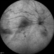 FEVR+ Optic Disc Hypoplasia 6 FEVR+ Optic Disc Hypoplasia 6