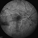 FEVR+ Optic Disc Hypoplasia 7 FEVR+ Optic Disc Hypoplasia 7