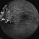 FEVR+ Optic Disc Hypoplasia FEVR+ Optic Disc Hypoplasia