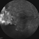 Peripheral Nonperfusion and Optic Disc Hypoplasia