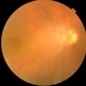 Familial Exudative Vitreoretinopathy (FEVR)
