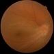 Familial Exudative Vitreoretinopathy (FEVR)