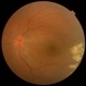 Familial Exudative Vitreoretinopathy (FEVR)