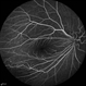 Familial Exudative Vitreoretinopathy (FEVR) Familial Exudative Vitreoretinopathy (FEVR)