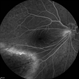 Familial Exudative Vitreoretinopathy (FEVR) Familial Exudative Vitreoretinopathy (FEVR)