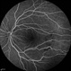 Familial Exudative Vitreoretinopathy (FEVR) Familial Exudative Vitreoretinopathy (FEVR)