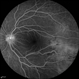 Familial Exudative Vitreoretinopathy (FEVR) Familial Exudative Vitreoretinopathy (FEVR)