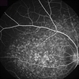 Fundus Flavimaculatus