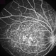 Fundus Flavimaculatus