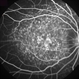 Fundus Flavimaculatus
