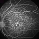 Fundus Flavimaculatus