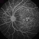 Fundus Flavimaculatus
