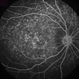 Fundus Flavimaculatus