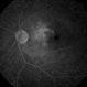 Choroidal Granuloma Secondary to Tuberculosis