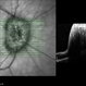 Papilledema Papilledema