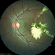 Coats Disease