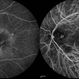 Polypoidal Choroidal Vasculopathy Polypoidal Choroidal Vasculopathy