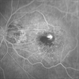 Myopic CNV Myopic CNV