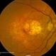 Age Related Macular Degeneration - Geographic Atrophy