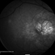 Age Related Macular Degeneration
