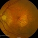 Age Related Macular Degeneration - Geographic Atrophy