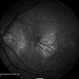 Age Related Macular Degeneration - Geographic Atrophy