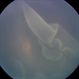 Giant Retinal Tear Giant Retinal Tear