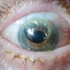 Gas Bubble in Anterior Chamber