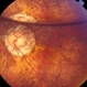 'Internal Mirroring' Effect by Intraocular Gas 'Internal Mirroring' Effect by Intraocular Gas
