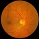 Combined Hamartoma of the Retinal Pigment Epithelium Case 2 Combined Hamartoma of the Retinal Pigment Epithelium Case 2