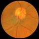 Combined Hamartoma of the Retinal Pigment Epithelium Case 2 Combined Hamartoma of the Retinal Pigment Epithelium Case 2