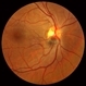 Melanocytoma Case 1 Melanocytoma Case 1