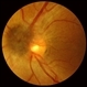 Combined Harmartoma of the Retinal Pigment Epithelium Case 1 Combined Harmartoma of the Retinal Pigment Epithelium Case 1