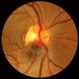 Melanocytoma Case 1 Slide 2 Melanocytoma Case 1 Slide 2