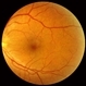 Combined Hamartoma of the Retinal Pigment Epithelium Case 1 Combined Hamartoma of the Retinal Pigment Epithelium Case 1