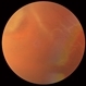 Rhegmatogenous Retinal Detachment Rhegmatogenous Retinal Detachment