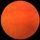 Rhegmatogenous Retinal Detachment Rhegmatogenous Retinal Detachment