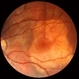 Choroidal Osteoma 2 Choroidal Osteoma 2