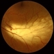 Myelinated retinal nerve fibers Slide 2 Myelinated retinal nerve fibers Slide 2