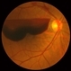 Valsalva retinopathy severe Valsalva retinopathy severe